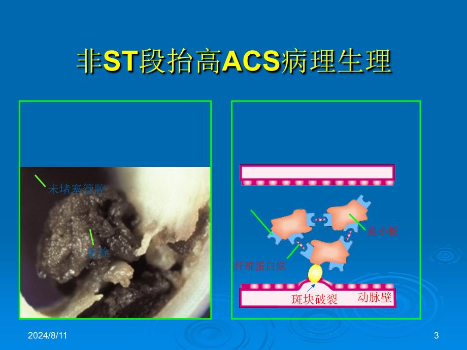 内科学教学课件：急性冠脉综合症的介入治疗_第3页