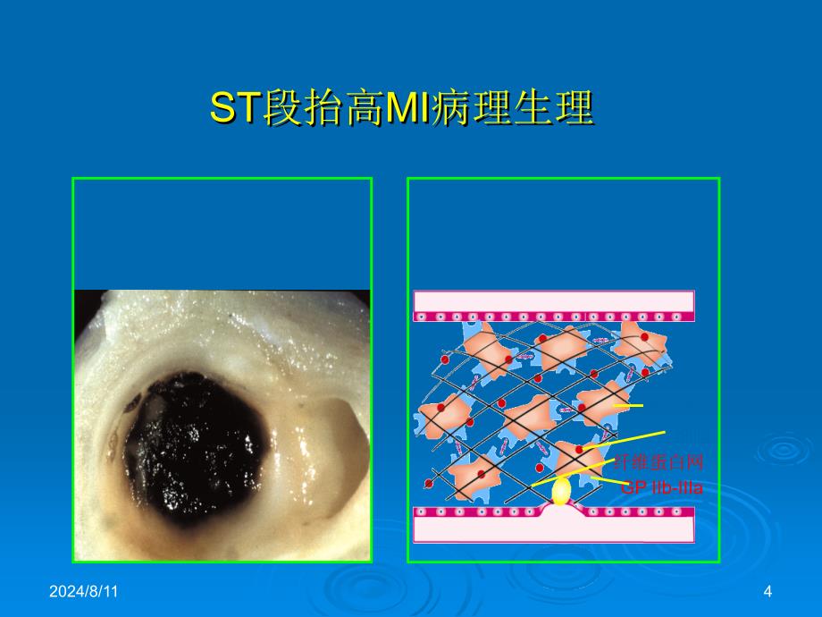 内科学教学课件：急性冠脉综合症的介入治疗_第4页