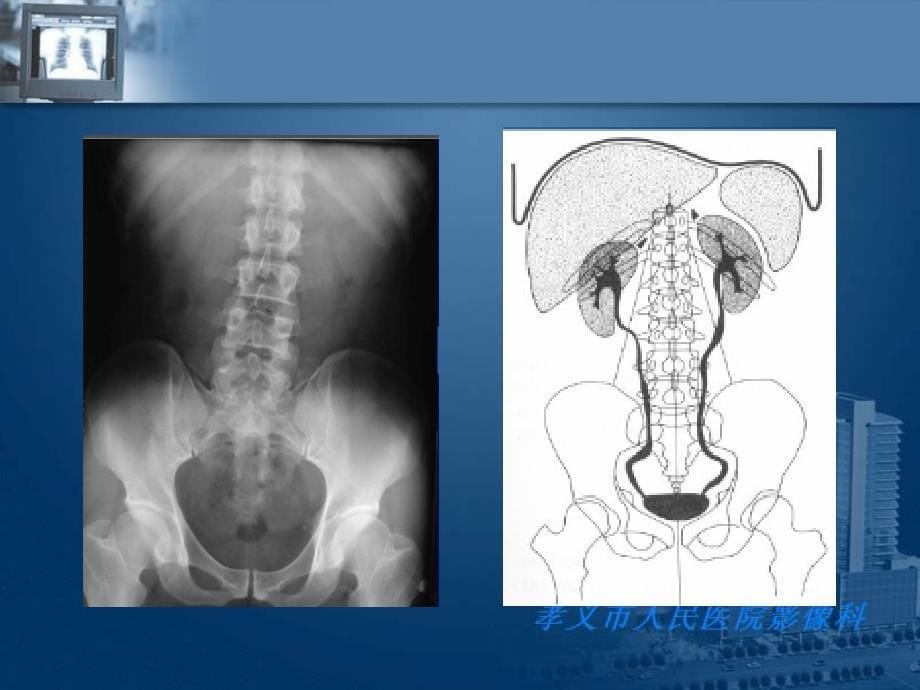 泌尿系结石的影像诊断_第5页
