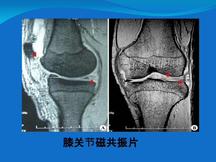 膝部疼痛康复治疗_第4页