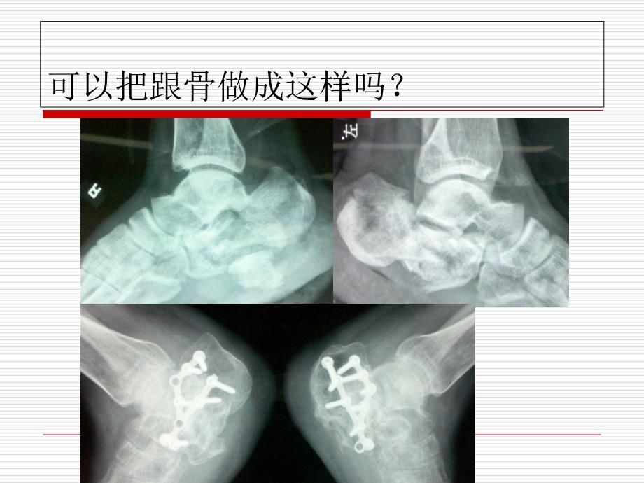 跟骨骨折ORIF的技巧_第3页