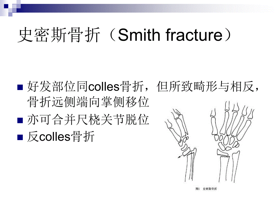 上肢骨折常见类型_第4页