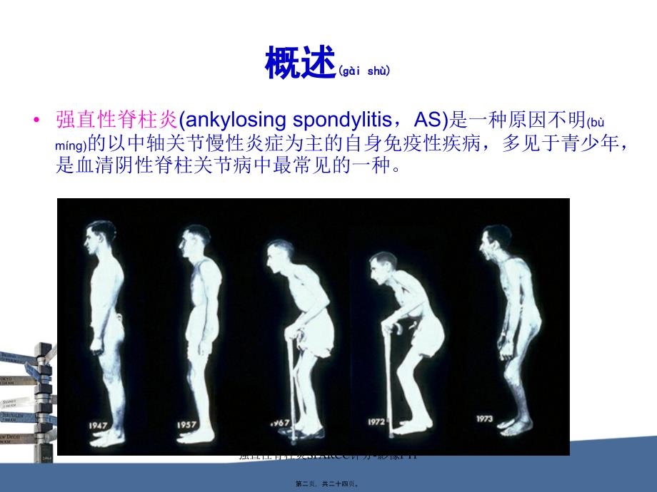 强直性脊柱炎SPARCC评分-影像FTP课件_第2页