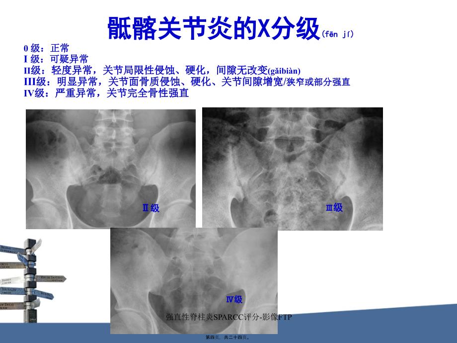 强直性脊柱炎SPARCC评分-影像FTP课件_第4页