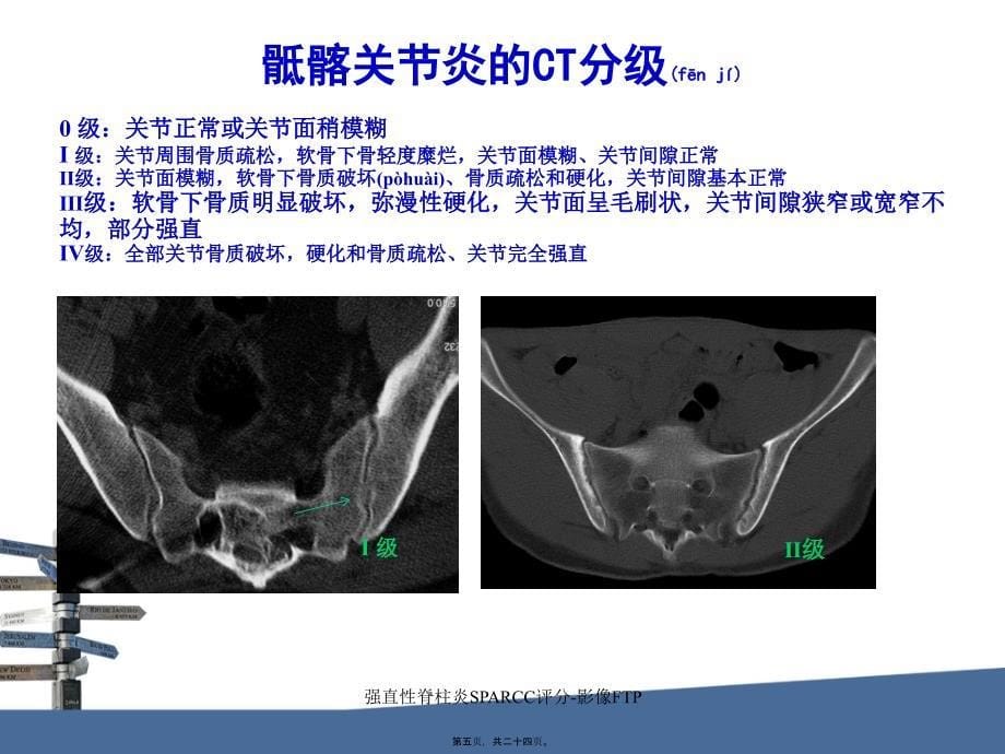 强直性脊柱炎SPARCC评分-影像FTP课件_第5页