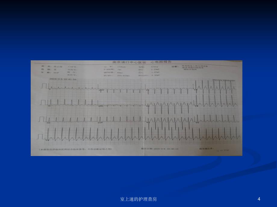 室上速的护理查房课件_第4页