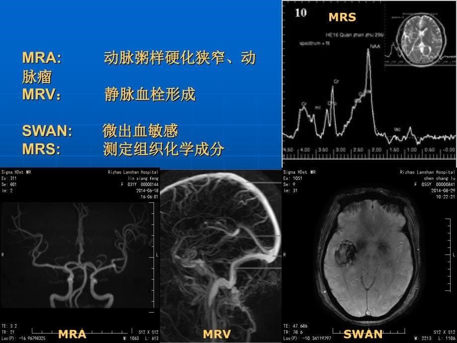 颅脑常见疾病MR表现_第5页