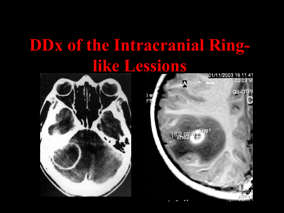 颅内环形占位性病变的影像学_第3页
