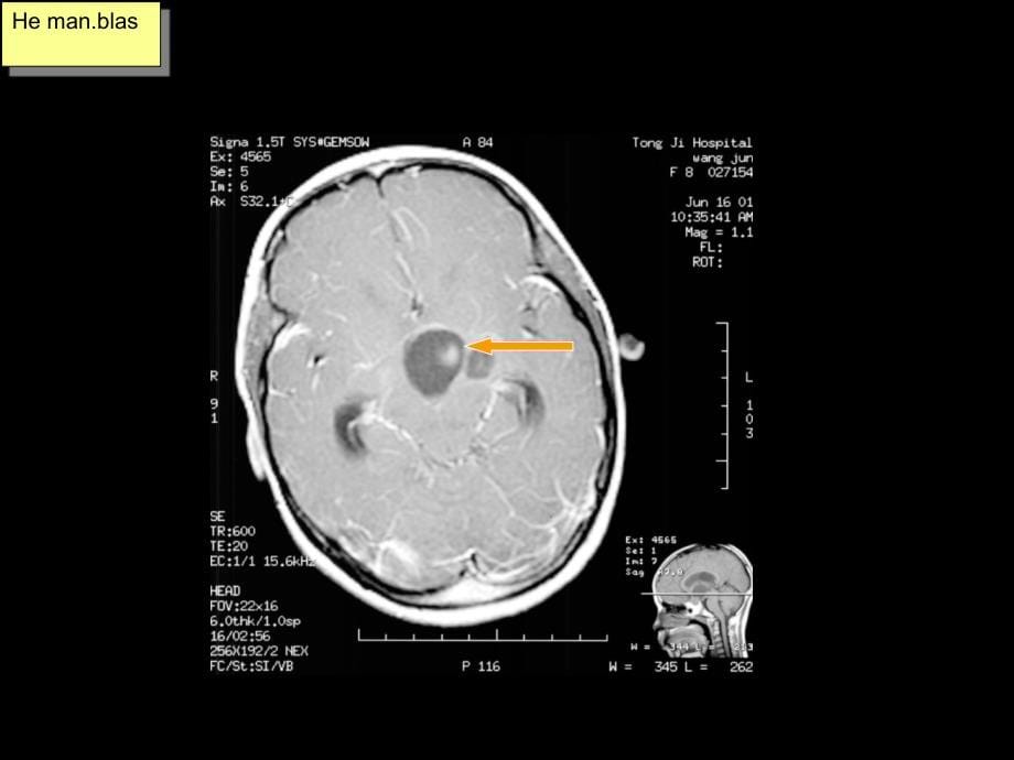 颅内环形占位性病变的影像学_第5页