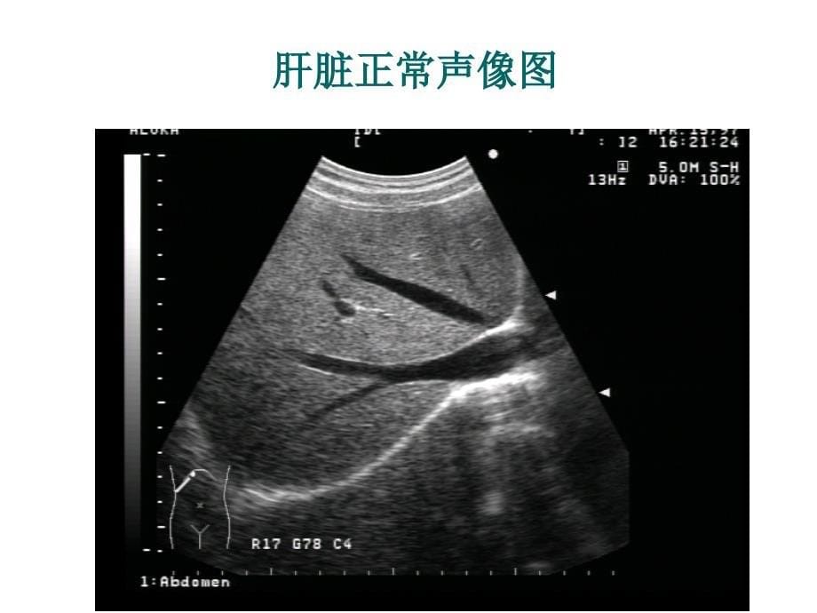 肝脏超声诊断学_第5页