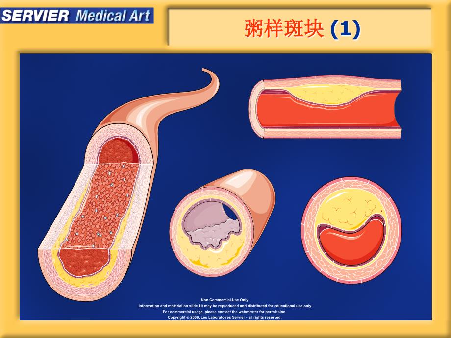 动脉粥样硬化精美图片课件.ppt_第2页