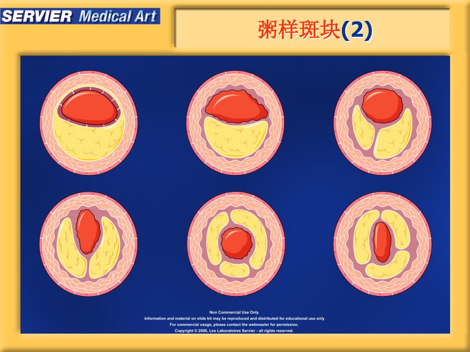 动脉粥样硬化精美图片课件.ppt_第3页