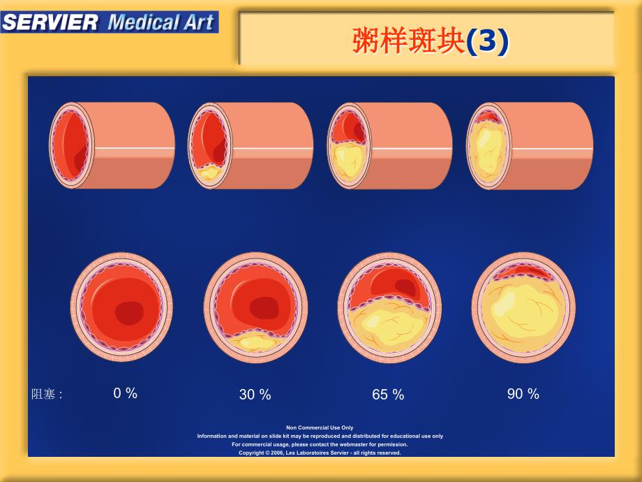 动脉粥样硬化精美图片课件.ppt_第4页