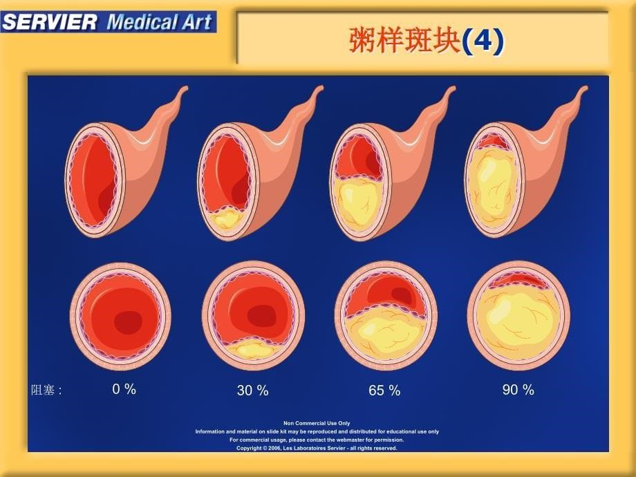 动脉粥样硬化精美图片课件.ppt_第5页