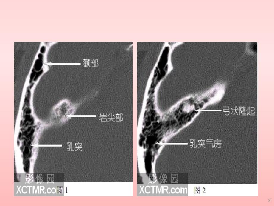 耳部最详细CT解剖ppt课件.ppt_第2页