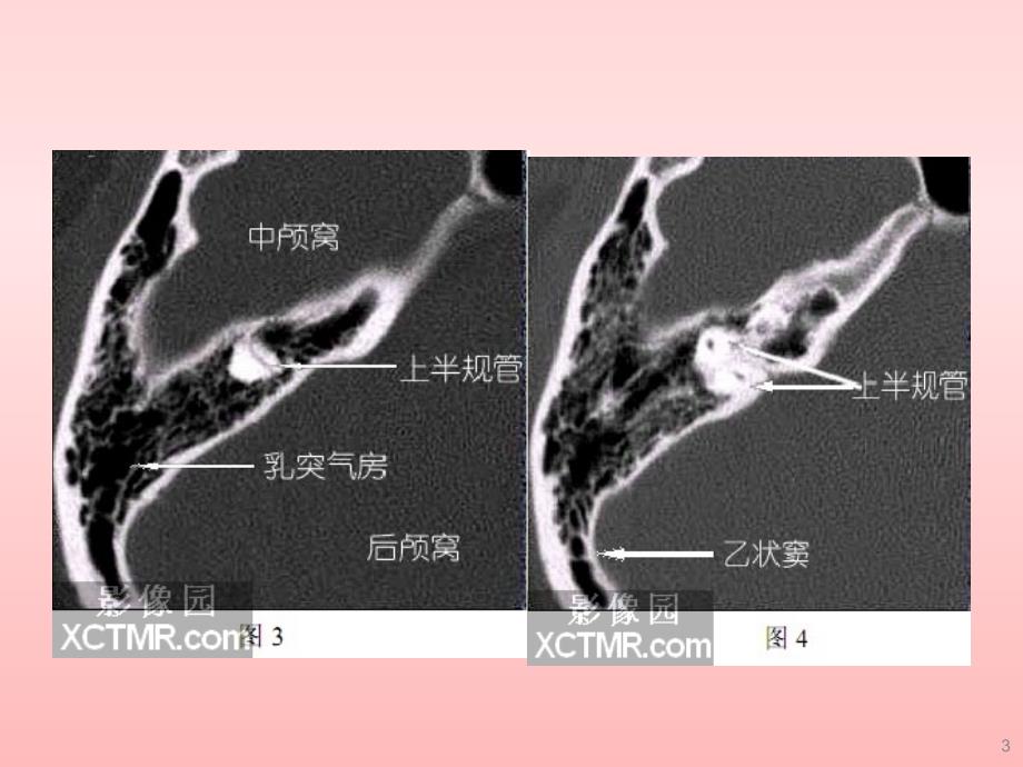 耳部最详细CT解剖ppt课件.ppt_第3页