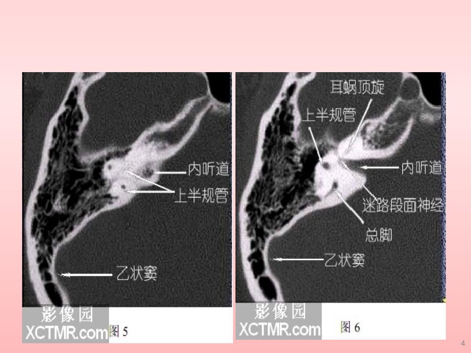 耳部最详细CT解剖ppt课件.ppt_第4页