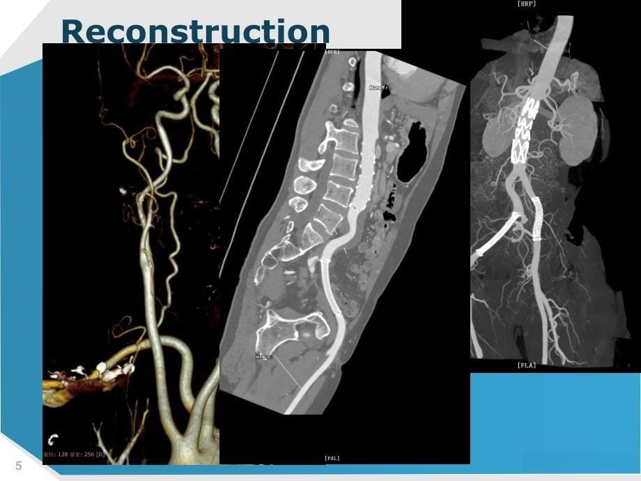主动脉病变CTA诊断住培_第5页