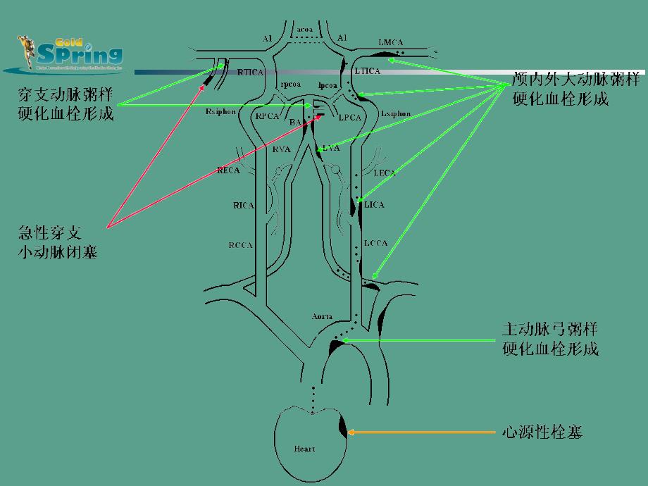 中国缺血性卒中亚型ppt课件_第3页