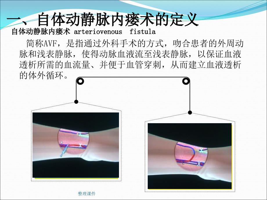 动静脉内瘘最新_第4页