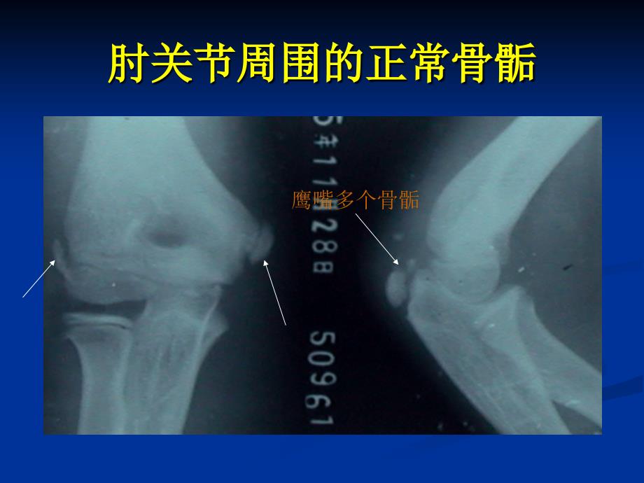 肱骨外髁骨折_第2页