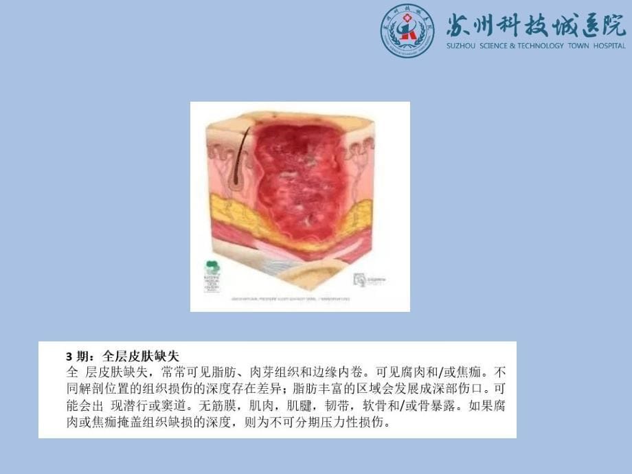 伤口敷料的选择及应用ppt件_第5页