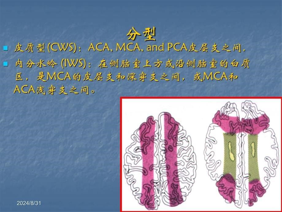 分水岭脑梗死和CT模板_第5页