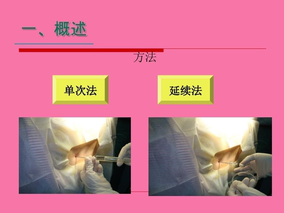 硬膜外麻醉我的讲ppt课件_第5页