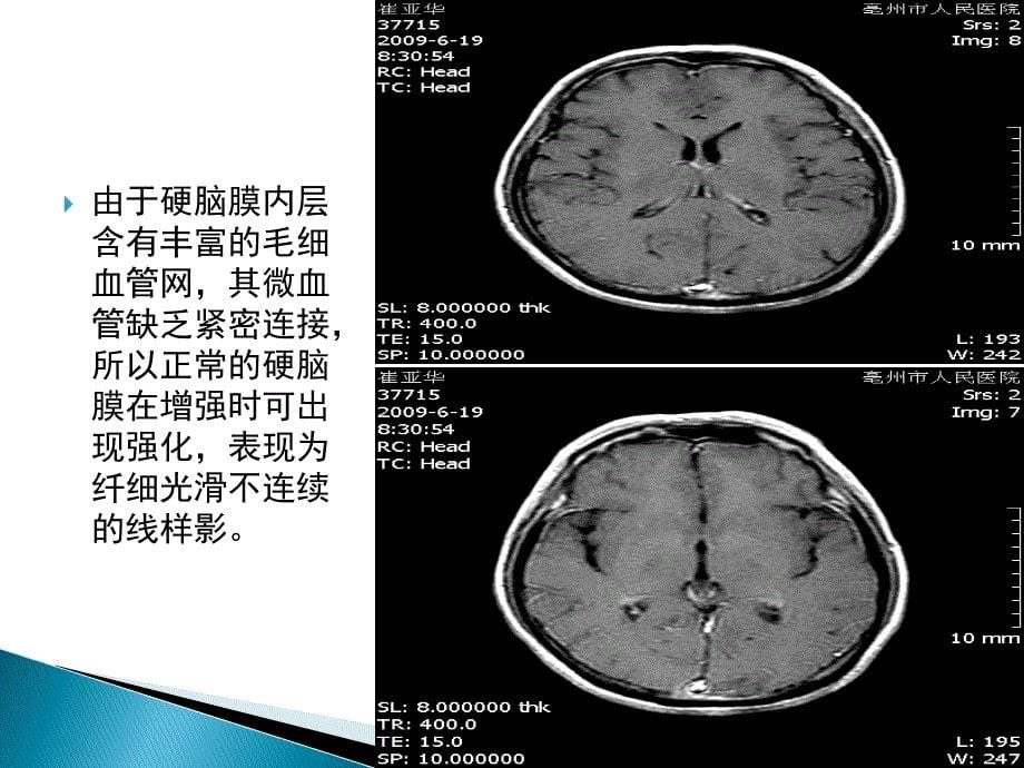 肥厚性硬脑膜炎!!_第5页