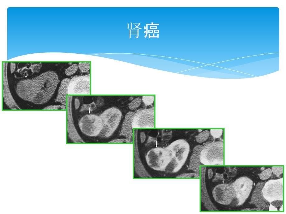 肾脏占位性病变鉴别诊断_第5页