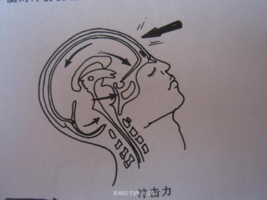 基础医学颅脑损伤课件_第4页