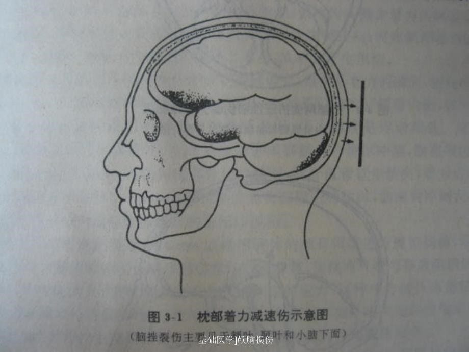 基础医学颅脑损伤课件_第5页