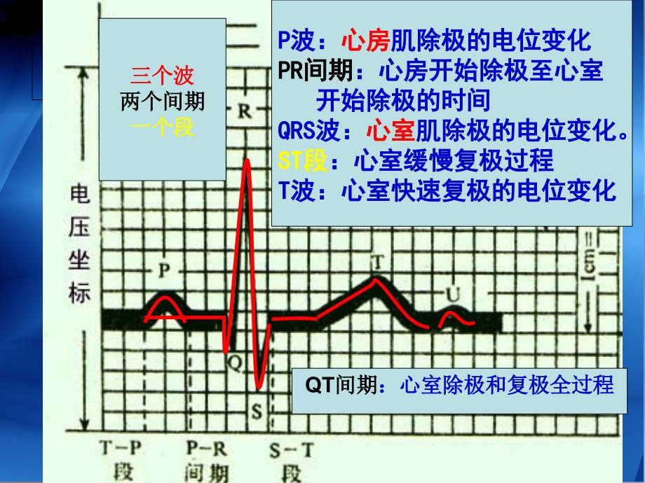 第三讲异常心电图课件_第3页