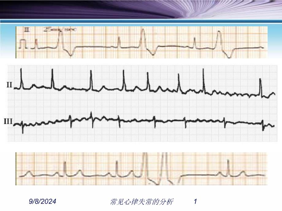 常见心律失常的分析ppt课件_第1页