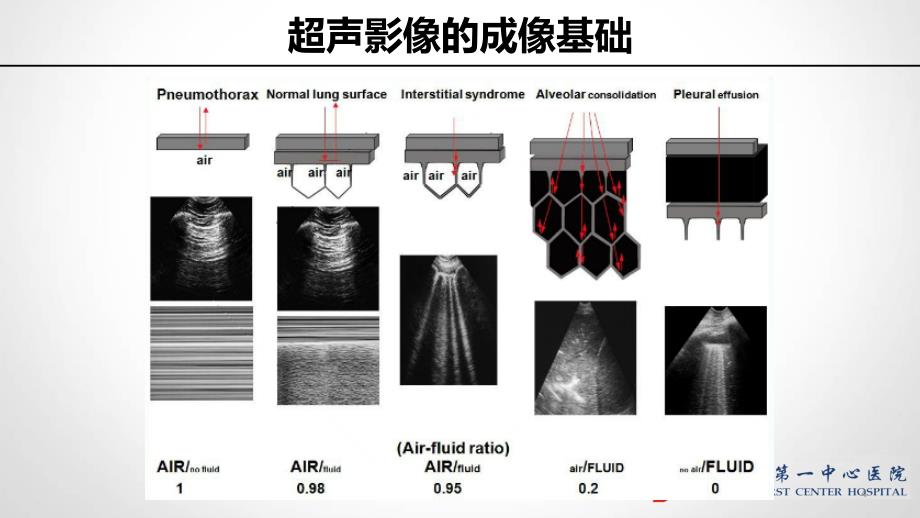 重症肺部超声PPT课件.ppt_第4页