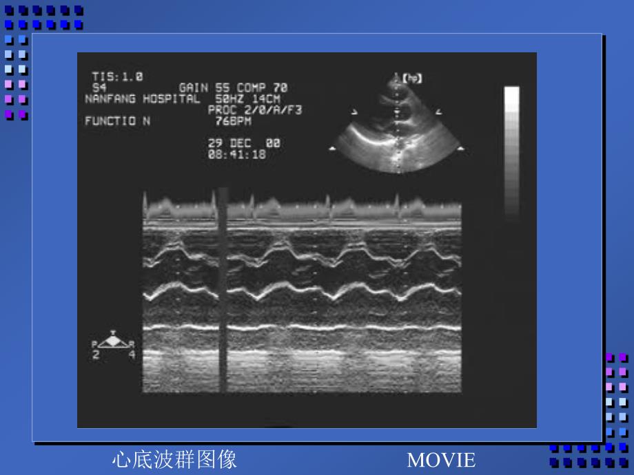 正常超声心动图(2)课件_第4页