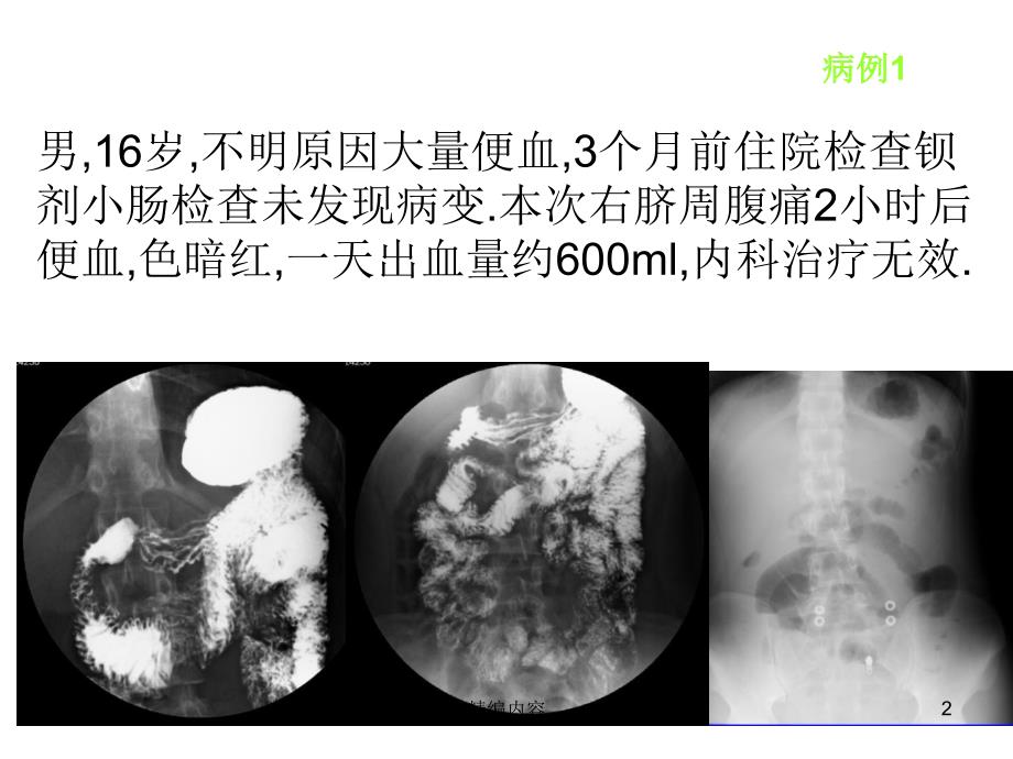 麦克尔憩室的影像学诊断（深度分析）_第2页