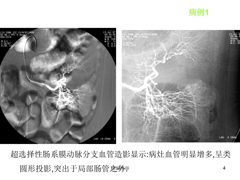 麦克尔憩室的影像学诊断（深度分析）_第4页