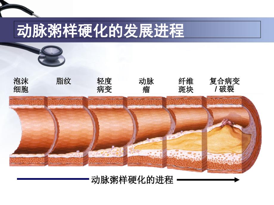 小讲课冠心病健康教育_第4页