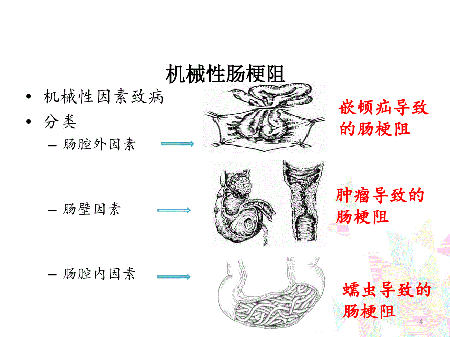 外科学-肠梗阻_第4页