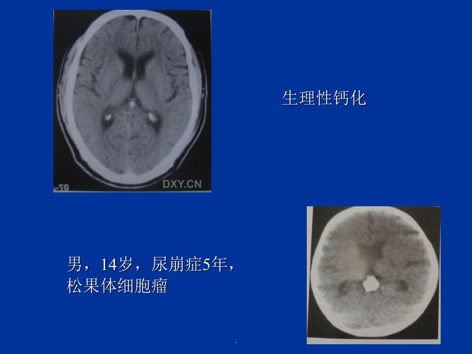 颅内钙化及其相关疾病ppt课件_第3页