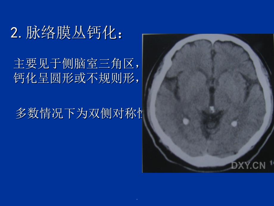 颅内钙化及其相关疾病ppt课件_第4页