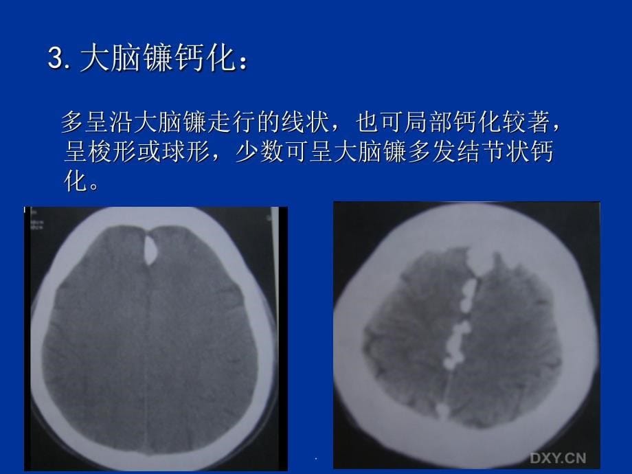 颅内钙化及其相关疾病ppt课件_第5页