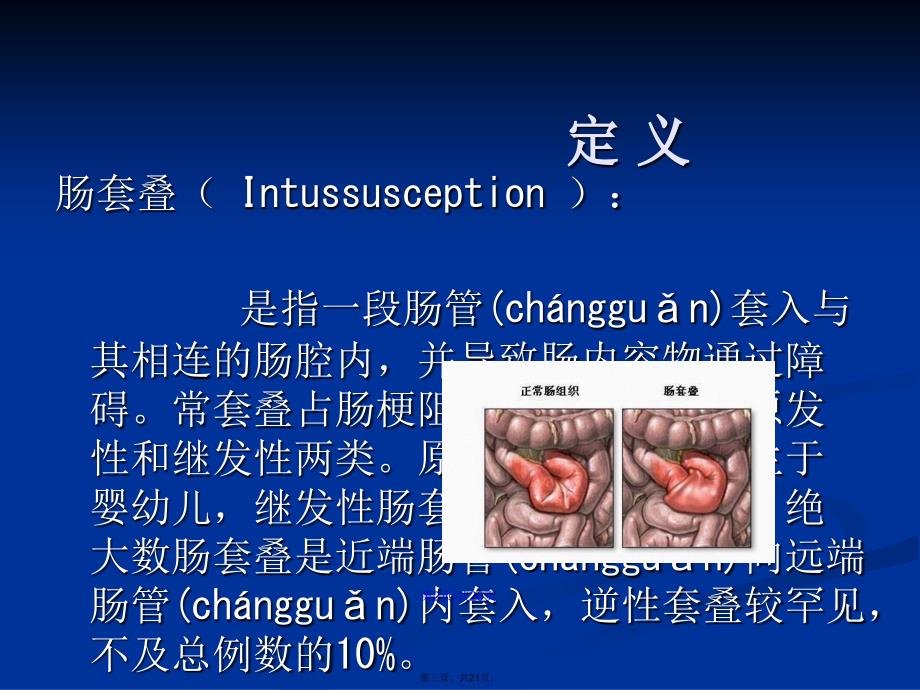 肠套叠的护理学习教案_第3页