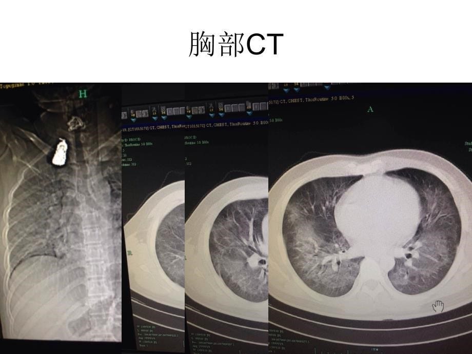 PCP病例分析及详解.ppt_第5页