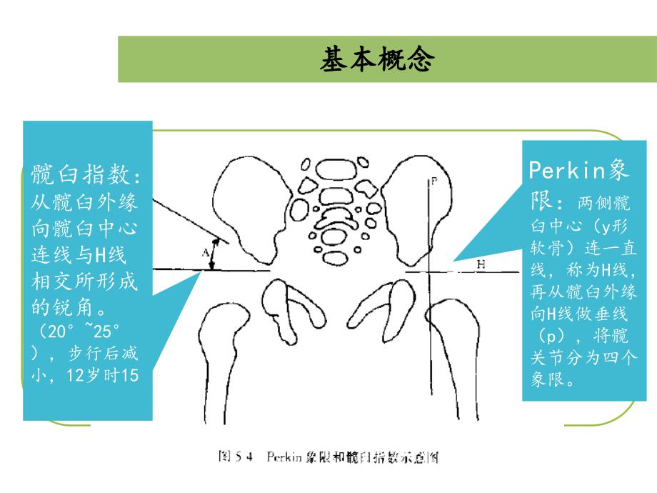 发育性髋关节脱位_第4页