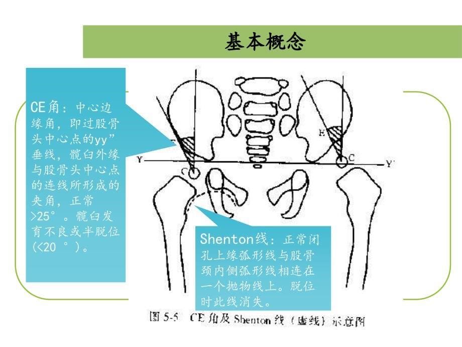 发育性髋关节脱位_第5页