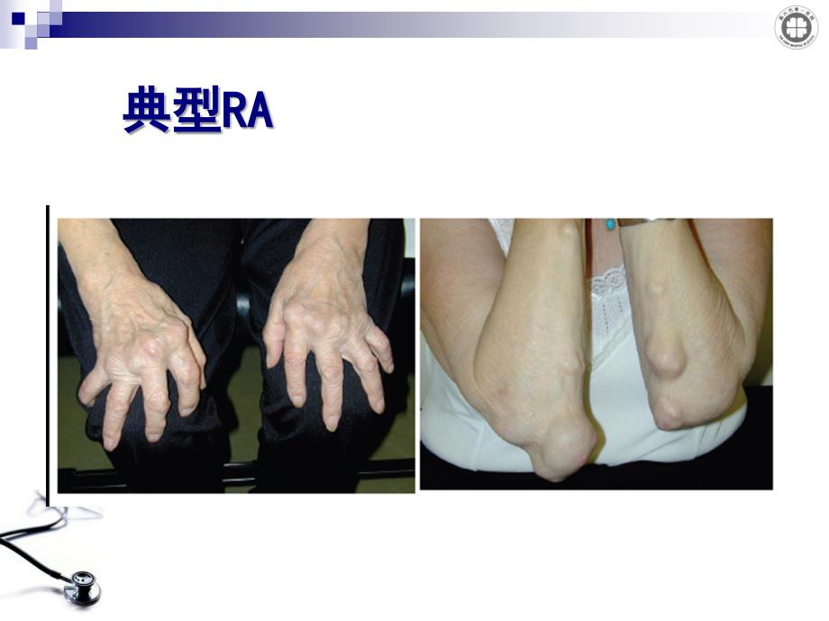 ACR及EULARRA新标准解读_第1页