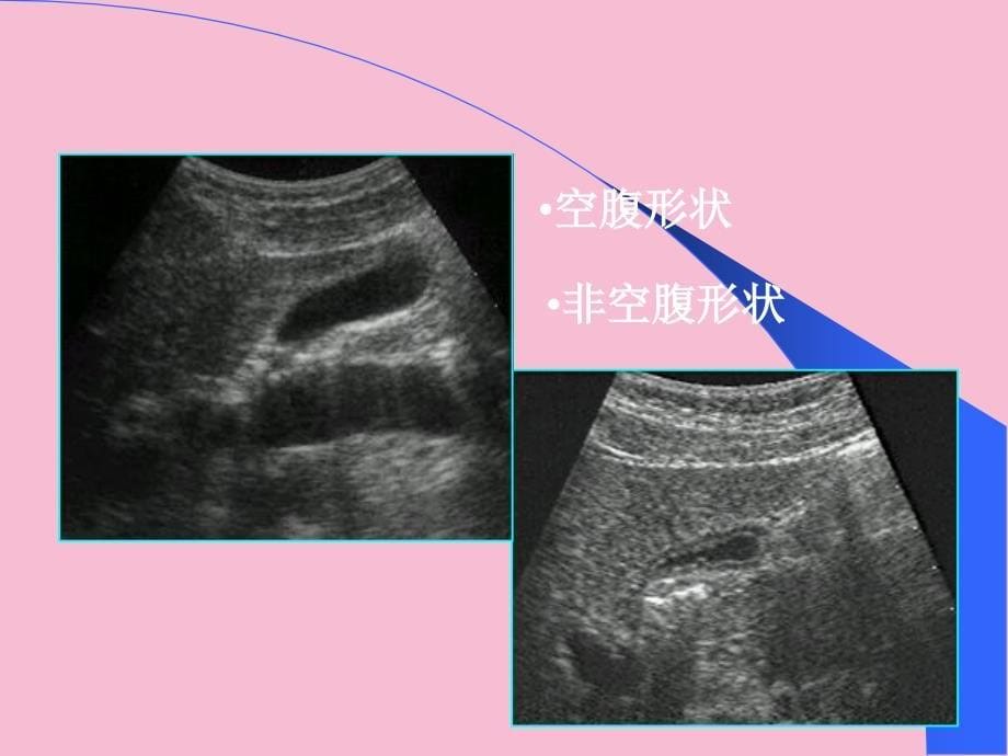 胆系超声检查PPT课件ppt课件_第5页