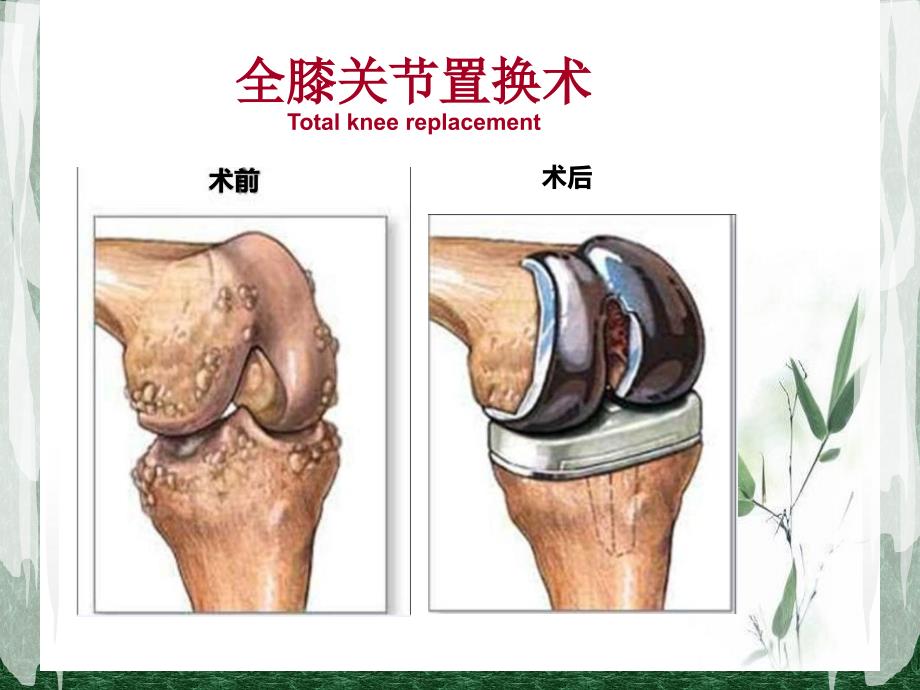 全膝关节置换术后护理_第3页